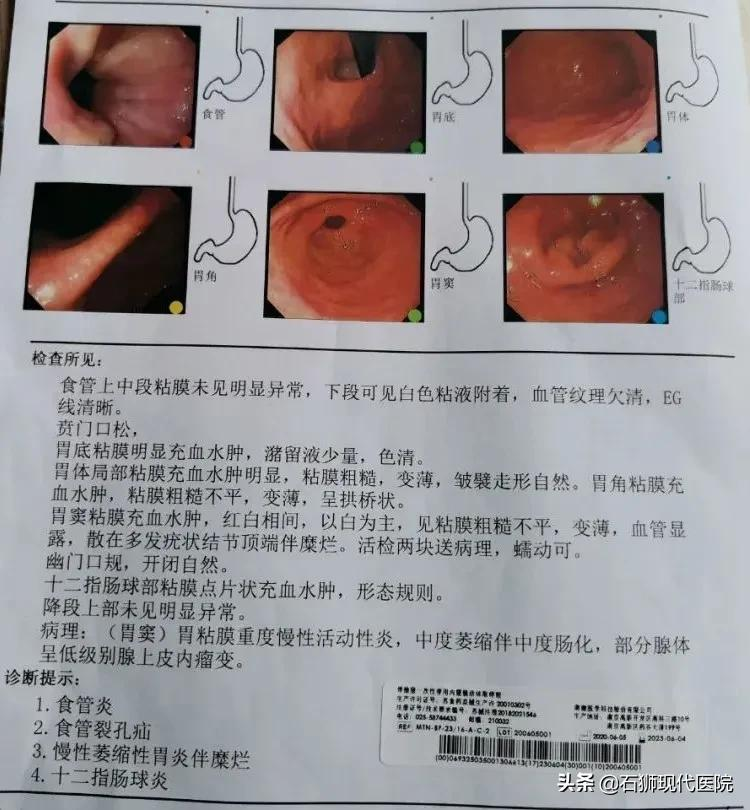 @石狮人!无痛胃镜全过程,看完再也不怕了