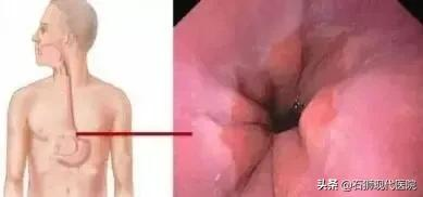 @石狮人!无痛胃镜全过程,看完再也不怕了