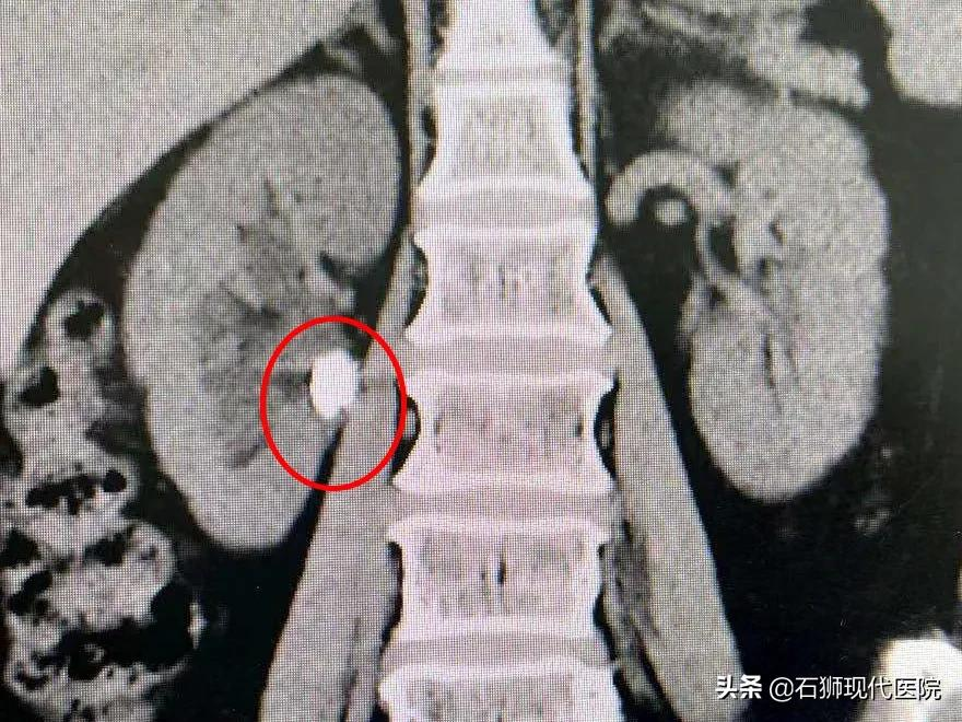腰痛难耐?血尿不止?有这些情况马上到医院就诊,肾会感激你