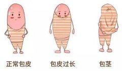 割包皮什么时候好？
