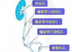 泌尿系结石爱招惹谁？怎么办？